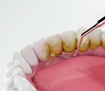 limpieza dental cancun